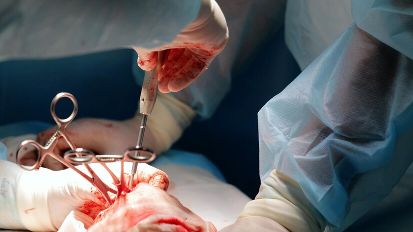 Organ Transplant